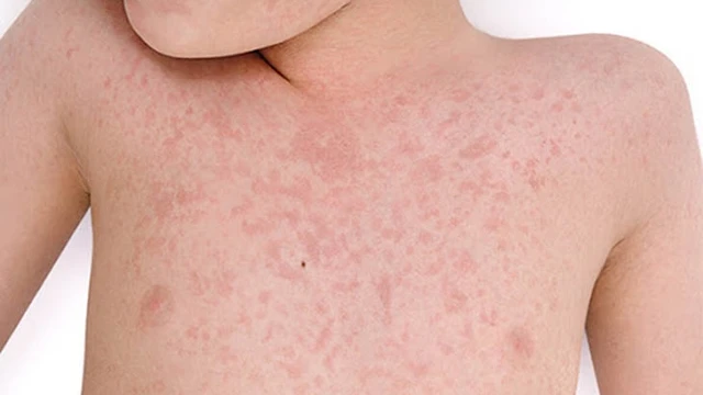 bai-viet/nguyen-nhan-nao-gay-ra-me-day-man-tinh-o-tre-em-54373.html