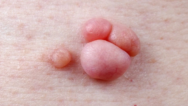 bai-viet/nguyen-nhan-sui-mao-ga-la-gi-phuong-phap-dieu-tri-sui-mao-ga.html