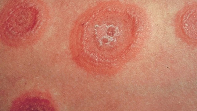 bai-viet/nguyen-nhan-trieu-chung-cua-hac-lao-sinh-duc-va-bai-thuoc-chua-tri-dan-gian-55281.html