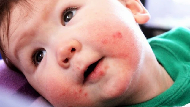 bai-viet/nguyen-nhan-va-cach-dieu-tri-khi-tre-bi-noi-me-day-quanh-mieng-54756.html