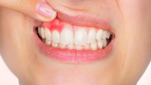 bai-viet/nguyen-nhan-va-cach-khac-phuc-hoi-mieng-chay-mau-chan-rang.html