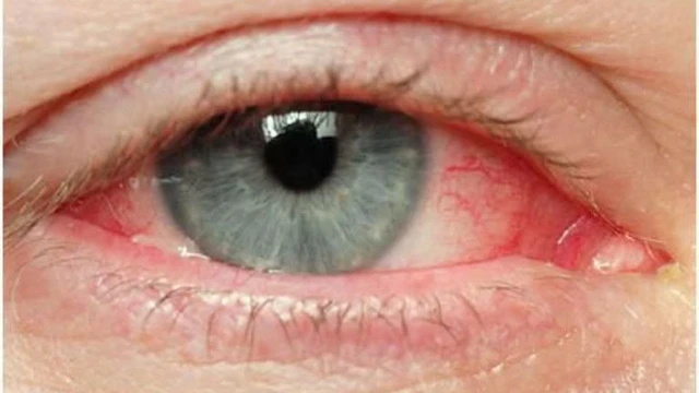 bai-viet/nhan-ap-la-gi-nhung-dieu-can-biet-truoc-khi-tien-hanh-do-nhan-ap.html