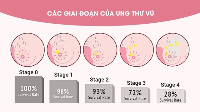 bai-viet/nhan-biet-cac-giai-doan-cua-ung-thu-vu.html
