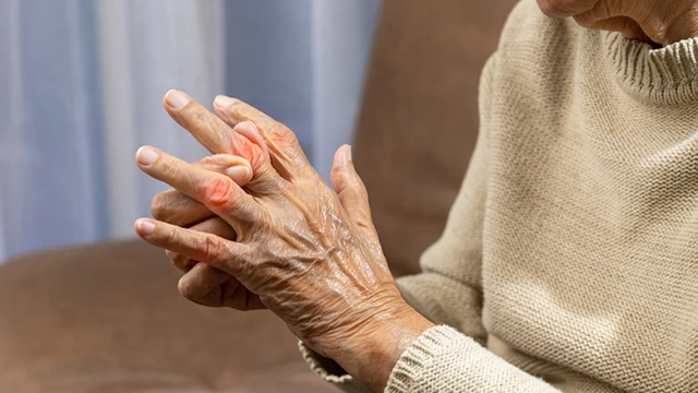 bai-viet/nhan-biet-dau-hieu-som-cua-viem-khop-vay-nen.html