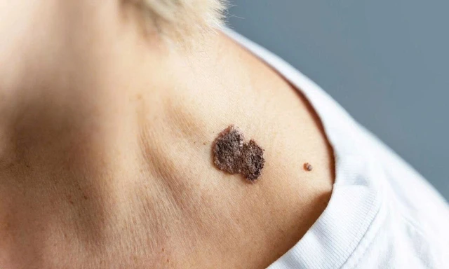 bai-viet/nhan-biet-dau-hieu-ung-thu-da-giai-doan-dau-de-phong-ngua-kip-thoi.html