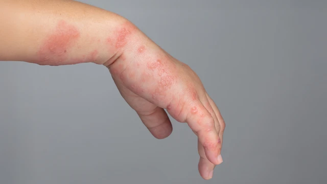 bai-viet/nhan-biet-hinh-anh-benh-ghe-o-tre-em.html