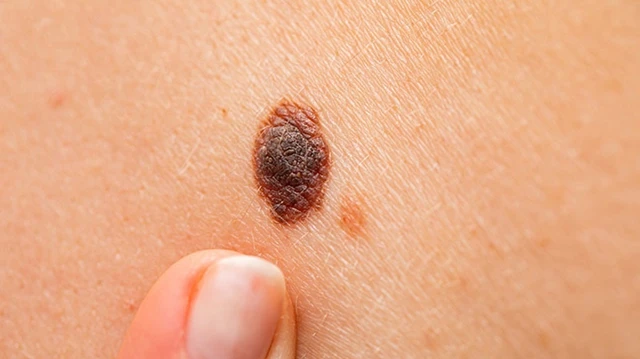 bai-viet/nhan-biet-hinh-anh-not-ruoi-ung-thu-dau-hieu-va-phuong-phap-sang-loc.html