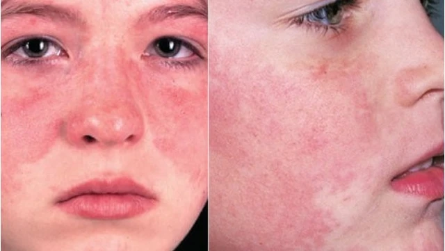 bai-viet/nhan-biet-lupus-ban-do-o-phu-nu-va-phuong-phap-dieu-tri-57136.html