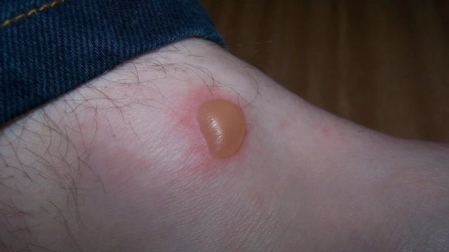 bai-viet/nhan-biet-vet-con-trung-can-bi-bong-nuoc-va-cach-xu-ly-cu-the-58238.html