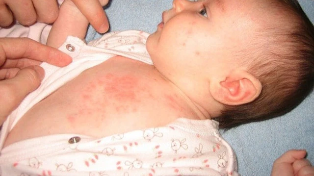 bai-viet/nhan-dien-hinh-anh-rom-say-o-tre-so-sinh-dau-hieu-va-giai-phap-dieu-tri.html