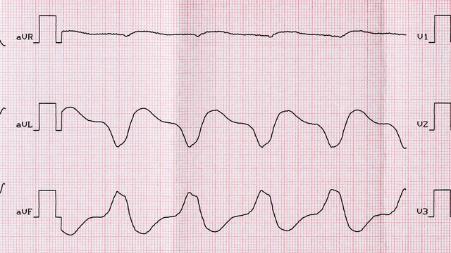 benh/nhip-nhanh-that-240.html