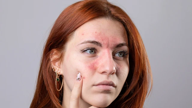 bai-viet/nhung-ai-de-mac-benh-lupus-cac-bien-phap-kiem-soat-benh-lupus-ban-do.html