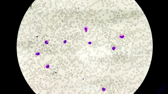 bai-viet/co-che-giam-tieu-cau-trong-sot-xuat-huyet-la-gi-hau-qua-cua-giam-tieu-cau-khi-bi-sot-xuat-huyet.html