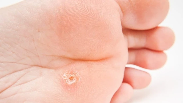 bai-viet/nhung-dau-hieu-va-trieu-chung-mun-coc-long-ban-chan.html