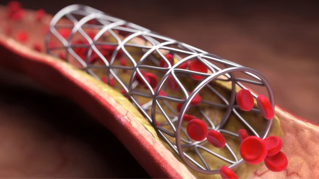 bai-viet/stent-mach-vanh-co-nhung-loai-nao-chi-dinh-va-bien-chung-co-the-gap-khi-dat-stent.html