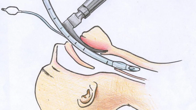 bai-viet/nhung-dieu-can-biet-ve-ky-thuat-dat-noi-khi-quan-duong-mui.html