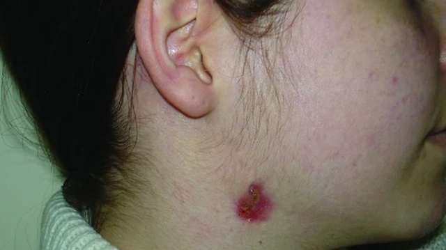 bai-viet/nhung-dieu-can-biet-ve-nang-va-ro-bam-sinh-vung-co.html