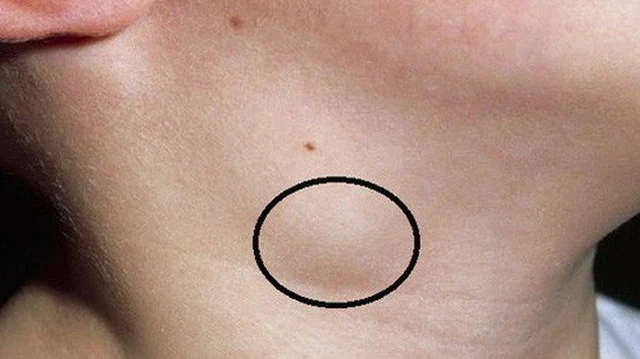 bai-viet/nhung-dieu-can-biet-ve-phu-bach-huyet-o-benh-nhan-ung-thu-54846.html