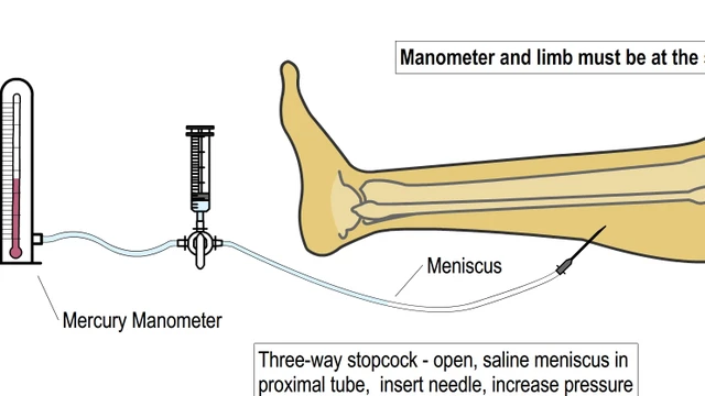 bai-viet/nhung-dieu-can-biet-ve-phuong-phap-whitesides-va-hoi-chung-chen-ep-khoang.html