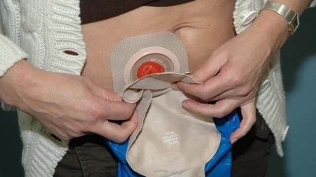 bai-viet/nhung-dieu-can-luu-y-khi-cham-soc-hau-mon-nhan-tao-59046.html