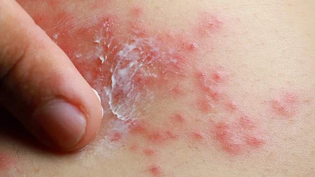 bai-viet/nhung-loai-thuoc-ngua-da-duoc-su-dung-pho-bien-va-mot-so-luu-y-can-biet.html