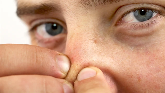 bai-viet/mot-cach-tri-mun-dau-den-tu-thien-nhien-tai-nha-ban-nen-biet.html