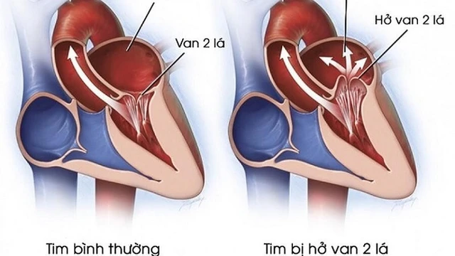 bai-viet/nhung-thong-tin-ban-can-biet-ve-cach-dieu-tri-ho-van-tim-2-la.html