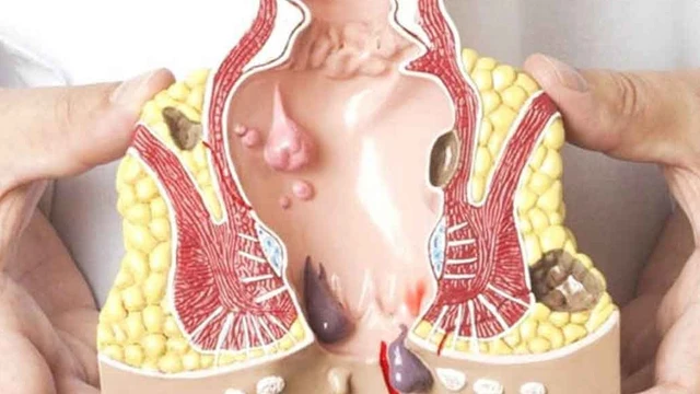 bai-viet/tri-ngoai-do-2-la-benh-ly-gi-dau-hieu-cua-tri-ngoai-do-2.html