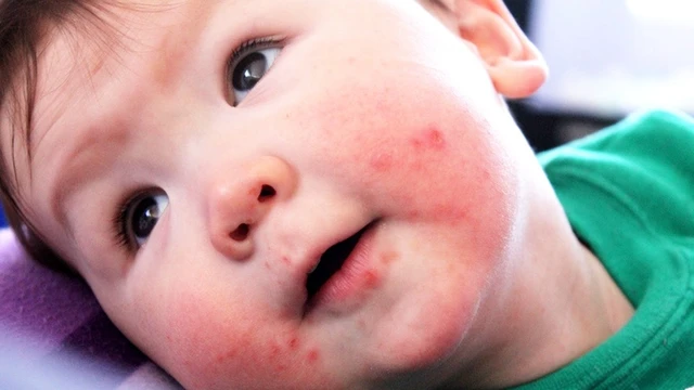 bai-viet/nhung-thong-tin-can-biet-khi-tre-bi-tay-chan-mieng-nhung-khong-sot.html