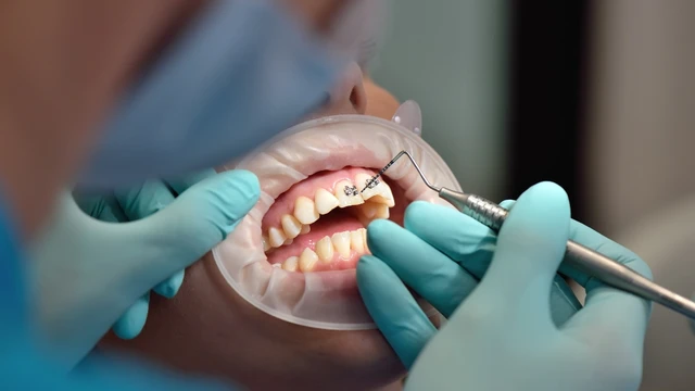 bai-viet/nieng-4-rang-cua-co-duoc-khong-luu-y-quan-trong-truoc-khi-quyet-dinh.html