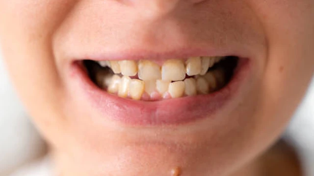 bai-viet/nieng-rang-khap-khenh-bao-nhieu-tien-va-nhung-dieu-can-biet-truoc-khi-nieng.html