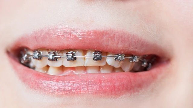 bai-viet/nieng-rang-thua-1-ham-gia-bao-nhieu-nhung-luu-y-can-biet-truoc-khi-nieng-rang.html