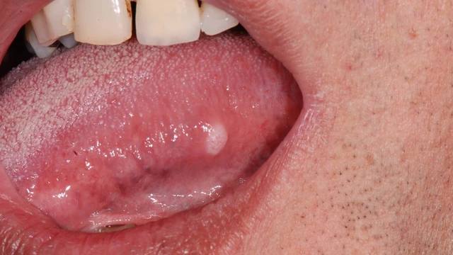 bai-viet/noi-hach-duoi-luoi-co-phai-la-dau-hieu-canh-bao-benh-ung-thu-luoi-khong.html