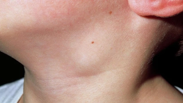 bai-viet/noi-hach-o-co-lau-ngay-la-benh-gi-co-nguy-hiem-hay-khong-62076.html