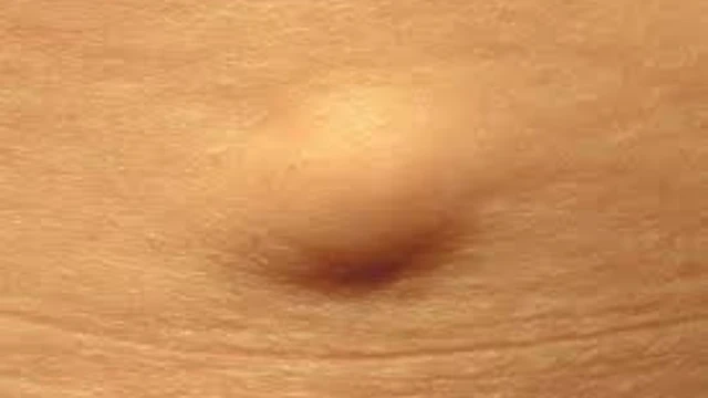 bai-viet/noi-hach-o-hang-o-nam-gioi-va-cach-chua-tri.html