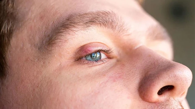 bai-viet/noi-hach-o-mi-mat-tren-nguyen-nhan-trieu-chung-va-cach-dieu-tri.html