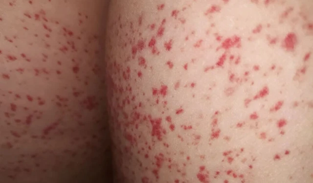 bai-viet/noi-man-do-o-mong-nhung-khong-ngua-la-bi-benh-gi.html