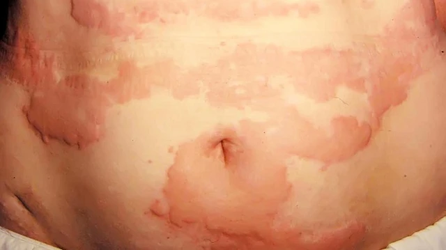 bai-viet/noi-me-day-quanh-bung-nguyen-nhan-dau-hieu-va-cach-dieu-tri-tri-54779.html