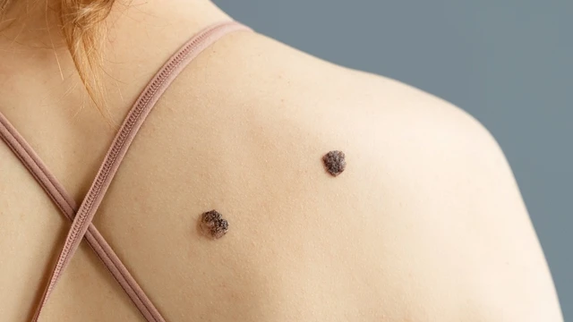 bai-viet/not-ruoi-ac-tinh-la-gi-cach-nhan-biet-not-ruoi-ac-tinh.html