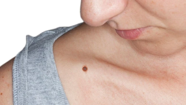 bai-viet/not-ruoi-son-o-co-phu-nu-xuat-hien-do-dau.html