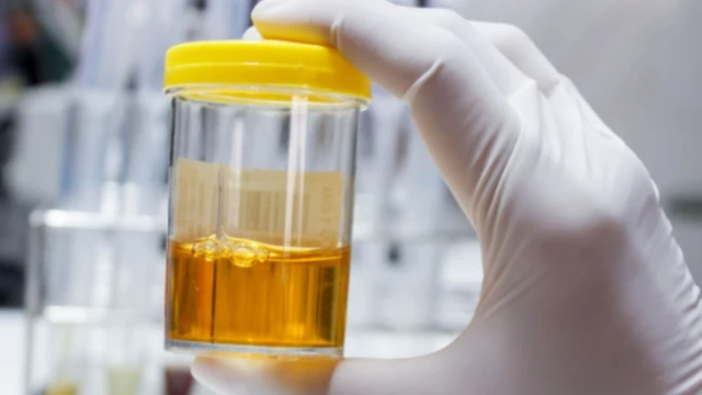 bai-viet/nuoc-tieu-sam-mau-do-nguyen-nhan-nao-gay-nen.html