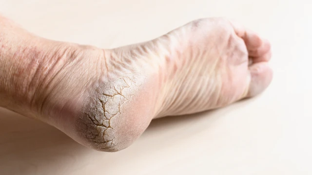 benh/nut-got-chan-1381.html