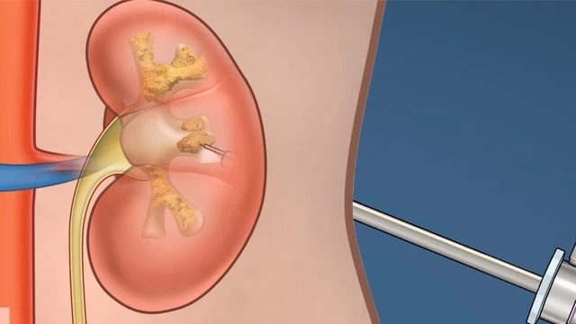 bai-viet/pcnl-la-gi-nhung-loi-ich-khi-ung-dung-pcnl.html