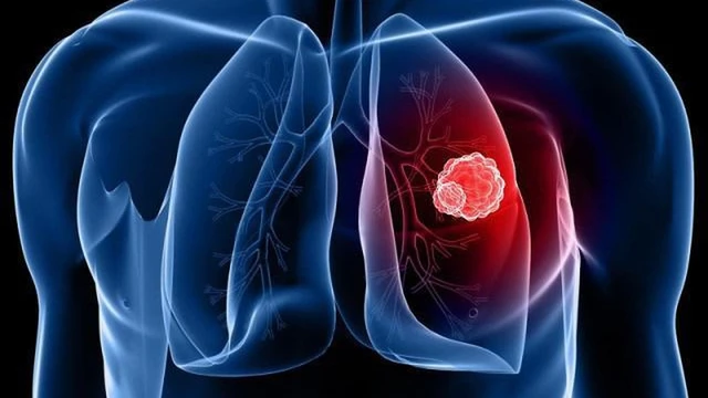 bai-viet/phac-do-dieu-tri-ap-xe-phoi-bo-y-te-va-cach-cham-soc-sau-dieu-tri.html