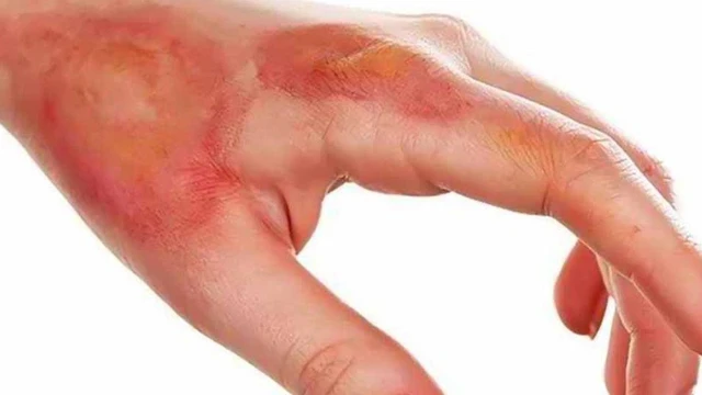 bai-viet/phac-do-dieu-tri-bong-bo-y-te-moi-nhat.html