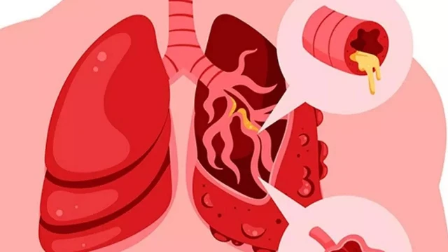 bai-viet/phac-do-dieu-tri-copd-bo-y-te-2023.html