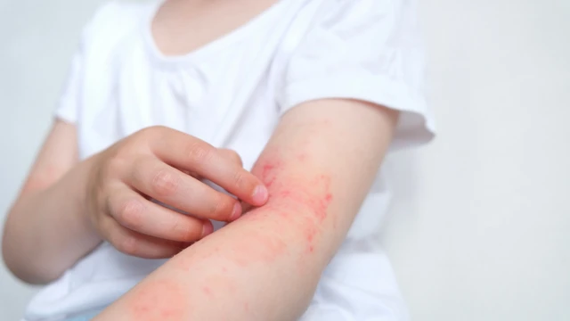 bai-viet/phac-do-dieu-tri-giun-dua-cho-bo-y-te-va-cach-phong-ngua.html