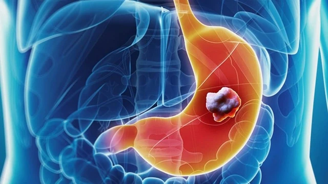 bai-viet/phac-do-dieu-tri-loet-da-day-ta-trang.html