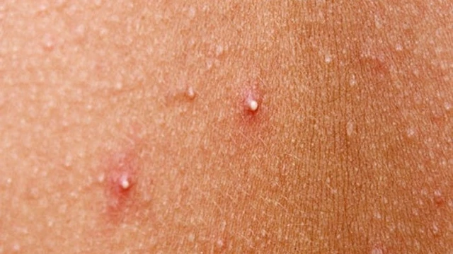 bai-viet/phai-lam-sao-khi-mong-bi-noi-mun-do.html