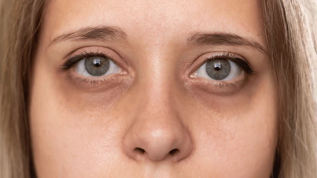 bai-viet/phan-biet-cac-loai-quang-tham-mat-pho-bien-va-cach-dieu-tri.html